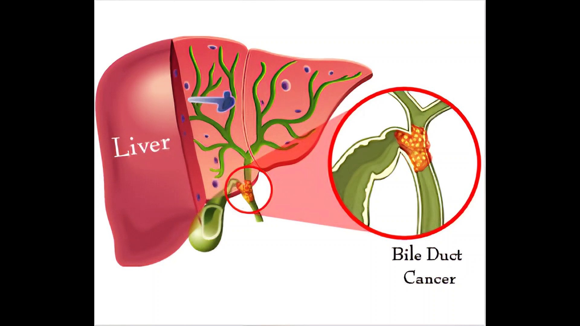 What Is Bile Duct Cancer