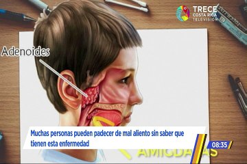 Mal aliento causado por caseum