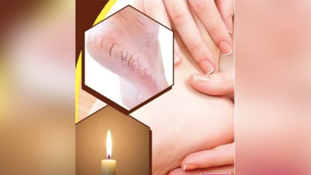 फटी एड़ियों ने कर दिया है शर्मिदा तो आजमाएं ये तरीका । Cracked Heels Remedy । Boldsky