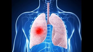 Atezolizumab + Carboplatin/Etoposide for Extensive-Stage Small Cell Lung Cancer: IMpower133 Update