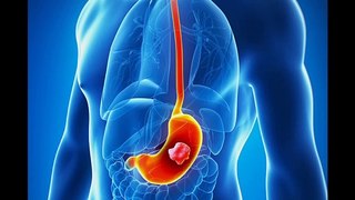 Bemarituzumab + Chemotherapy Improve Outcome in Advance Gastric and Gastroesophageal Junction Cancer