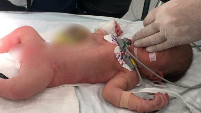 İç organları dışarıda doğdu, bir günlükken ameliyat oldu