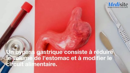 Comment le Bypass permet de mincir