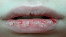 होंठ फटने का असली कारण क्या है | होंठ फटने की असली वजह | Hoth Fatne Ka Karan Kya Hai | Boldsky
