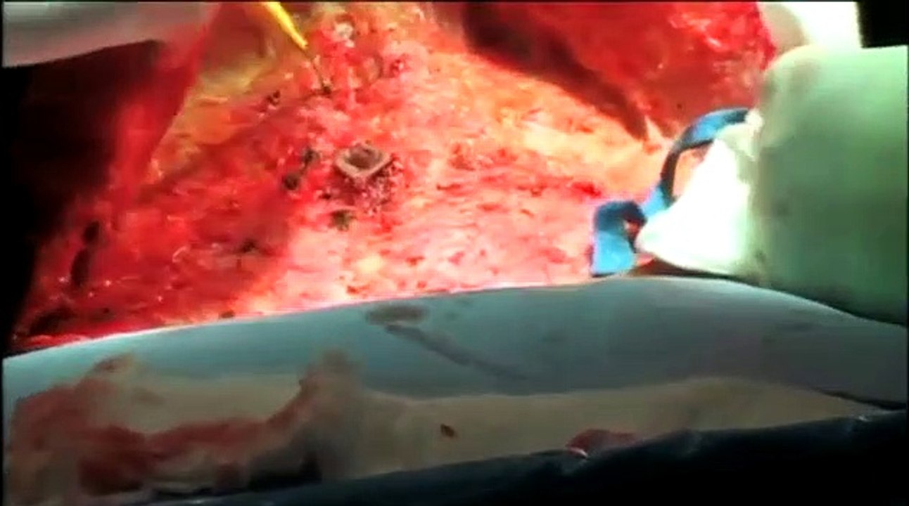 Tummy Tuck (Abdominoplasty) in Northern California - Steven K. Struck, M.D.