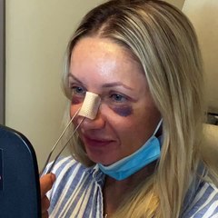 Rhinoplasty Nose Job Reveal