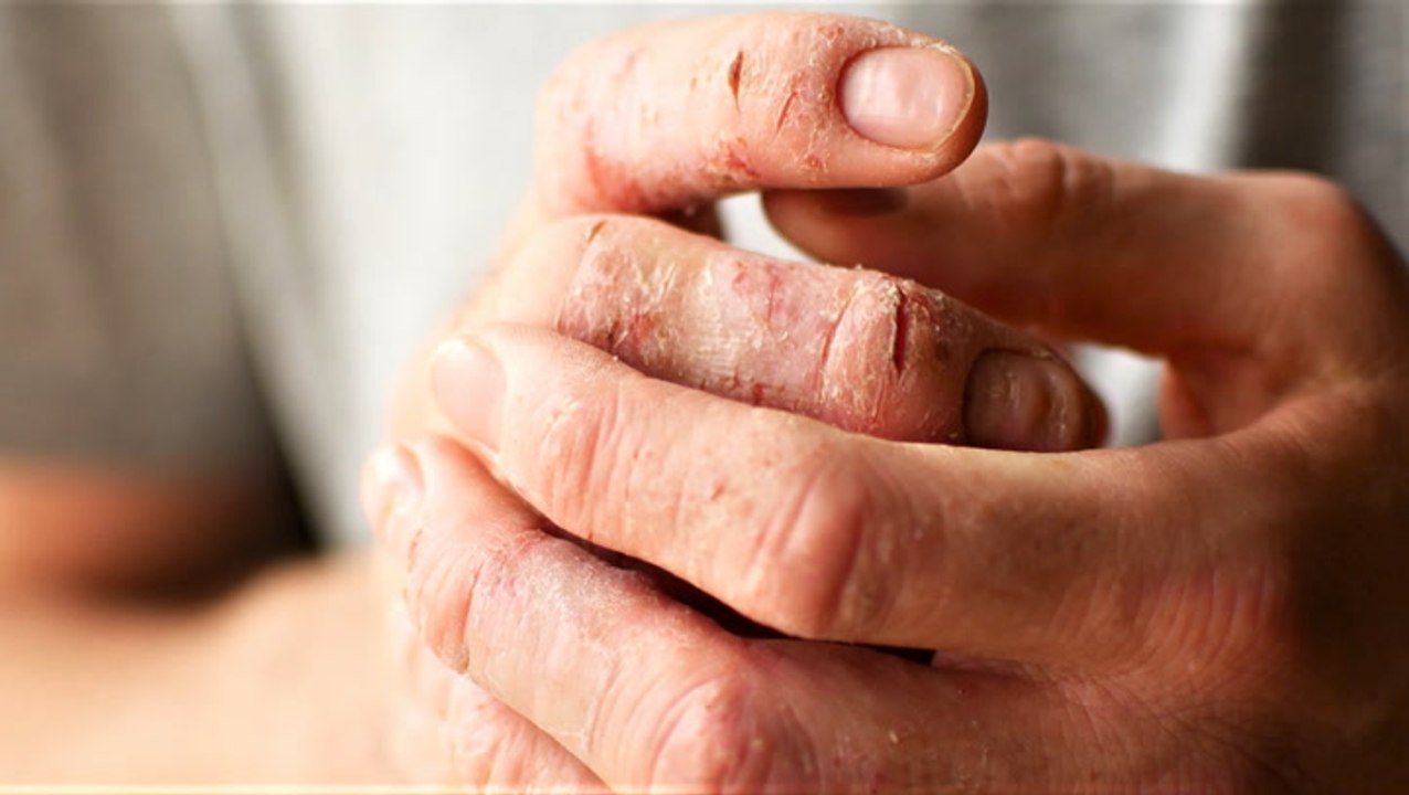 Rescuing dry skin during the winter