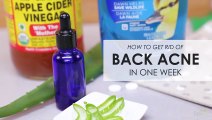 How to get a rid of back acne in one week .|Does Baking Soda Get Rid of Acne? | Acne Treatment|How To Use Baking Soda For Acne Scars - Acne Treatment.