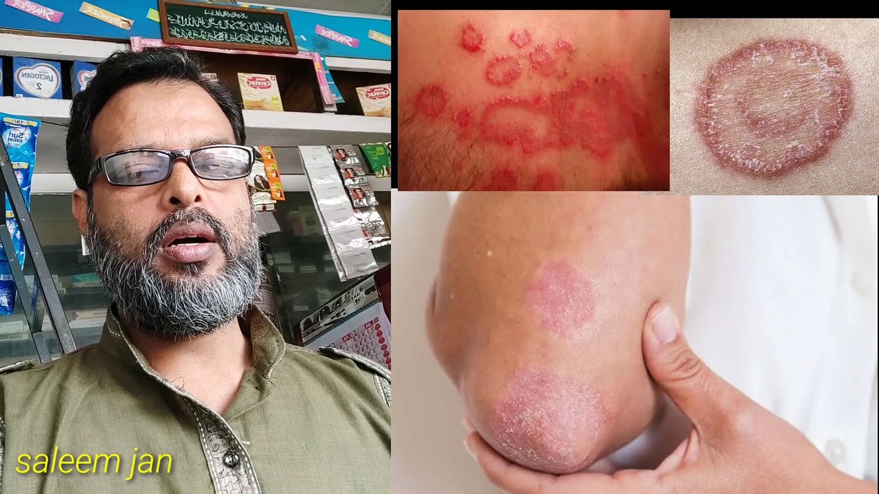 Skin Fungal infection treatment video Dailymotion