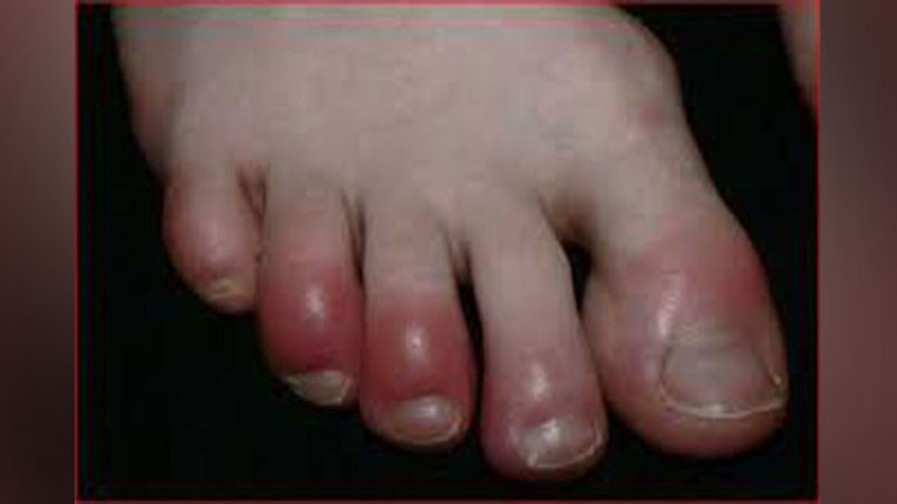 Finger Swelling in Winter | सर्दियों में उंगलियों की सूजन ऐसे करें दूर | Boldsky