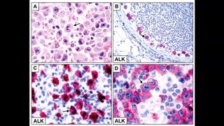 Late Relapse of ALK-Positive Anaplastic Large Cell Lymphoma Successfully Cleared by Crizotinib