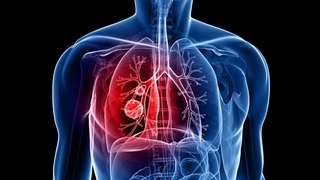 FDA approves osimertinib as adjuvant therapy for non-small cell lung cancer with EGFR mutations