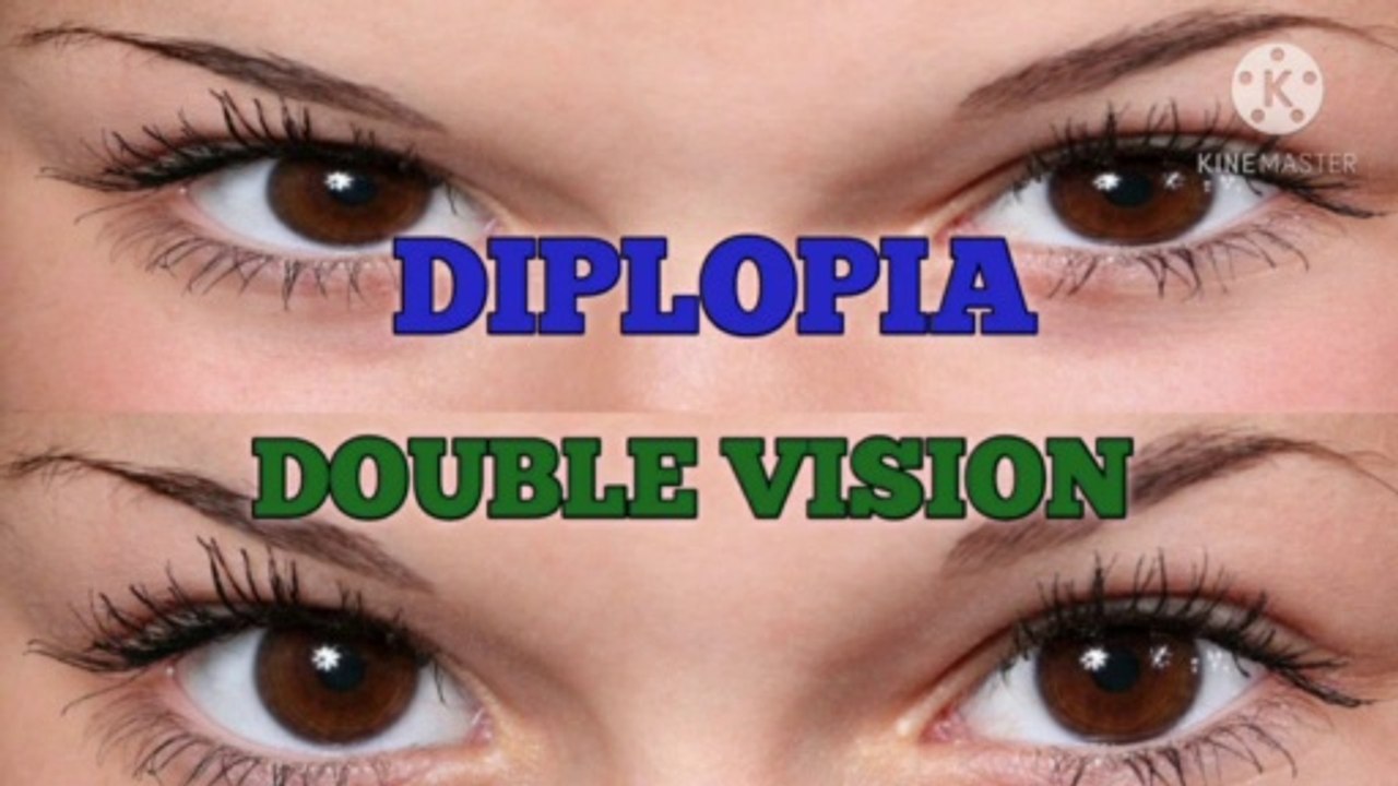 Double Vision || Diplopia In Hindi