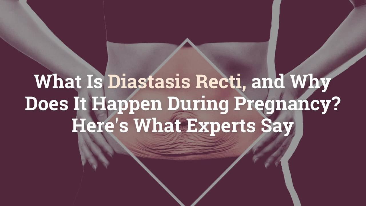 What Is Diastasis Recti, and Why Does It Happen During Pregnancy? Here's What Experts Say