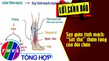 Suy giãn tĩnh mạch: “Sát thủ” thầm lặng của đôi chân