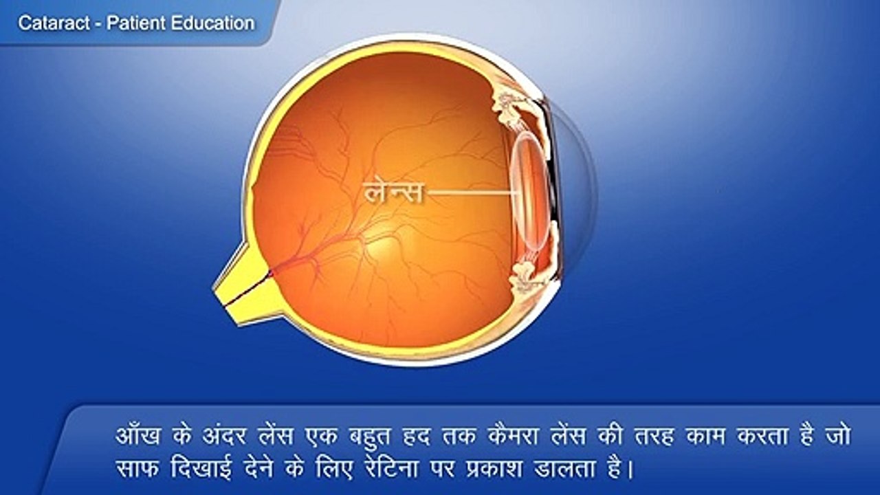 1 What is Cataract (Hindi)