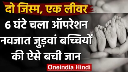 Mumbai के Wadia Hospital  में Twins Sister की हुई चमत्कारी Surgery । वनइंडिया हिंदी