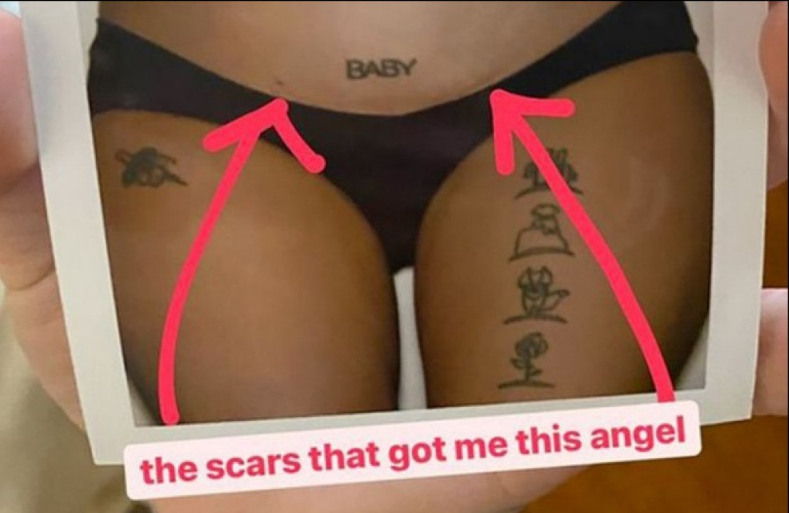 Halsey zeigt Narben von Endometriose-Operation