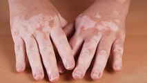 World Leprosy Day: कैसे होता है कुष्ठ रोग और क्या है इसके लक्षण| Leprosy Treatment & Cause | Boldsky