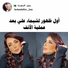 شيماء علي في أول ظهور لها بعد عملية الأنف