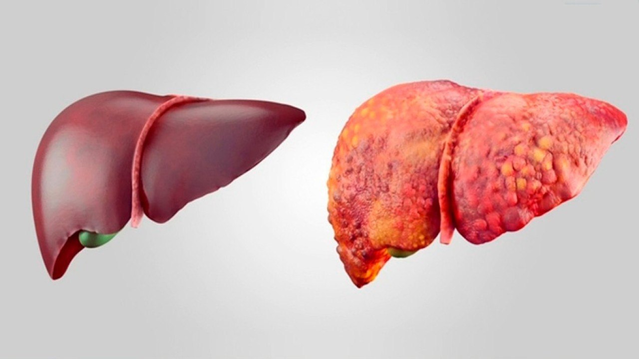 bd-causas-y-tratamientos-del-higado-graso-010221