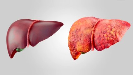 bd-causas-y-tratamientos-del-higado-graso-010221