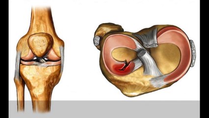 Menisküs yırtıklarının dereceleri ve belirtileri!