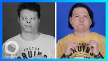 Pertama di Dunia: Transplantasi Wajah dan Tangan Ganda Pria New Jersey - TomoNews