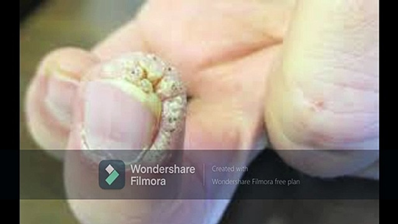 How to Remove Warts1