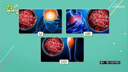 그것이 궁금하다 ◆죽음의 덩어리◆ 혈전의 위험성 TV CHOSUN 20210207 방송