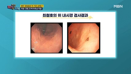 3년간 지속된 소화불량! 최철호, 위에 상처가 있다?