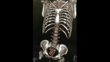 Beş İranlı’nın sindirim sisteminden 292 uyuşturucu kapsülü çıktı