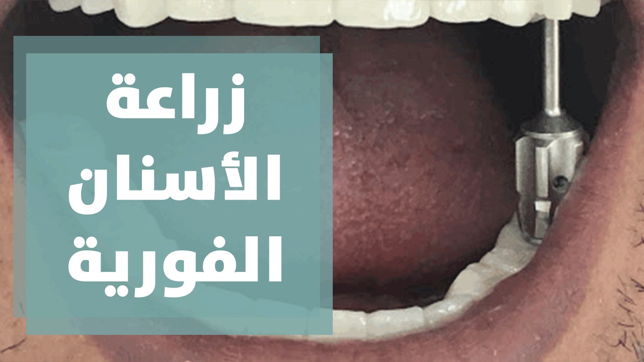 زراعة الأسنان الفورية - المركز الألماني لزراعة الأسنان