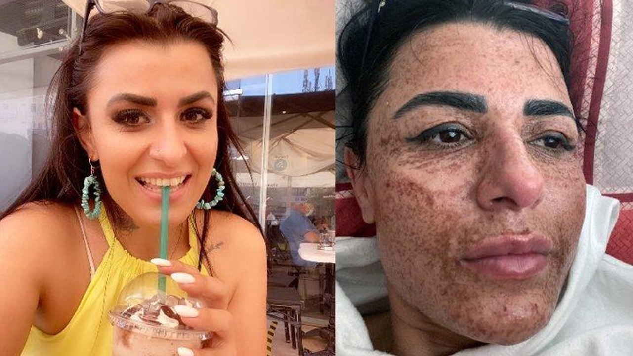 Güzellik merkezinde yüzü yanan Aslı: Sosyal medyadaki reklamlarına kandım