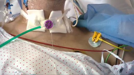 Así es el durísimo día a día de los pacientes 'extubados' tras contagiarse de la covid