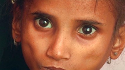 Half of Yemeni children under 5 face acute malnutrition: UN