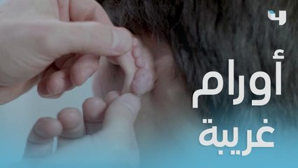 بعد ما أجرى عملية تجميل لأذنه فوجئ بأورام غريبة مكانها.. لكن د عادل سيخلصه منها