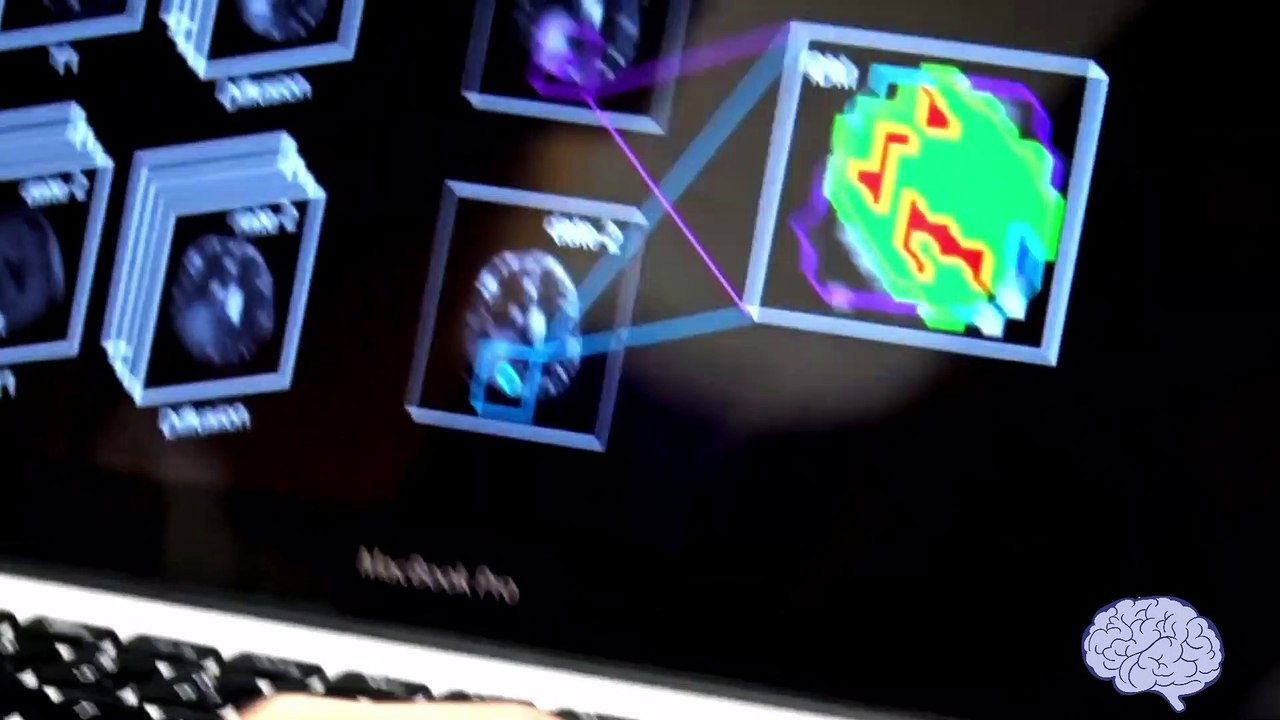 Biomarcador tumor cerebral