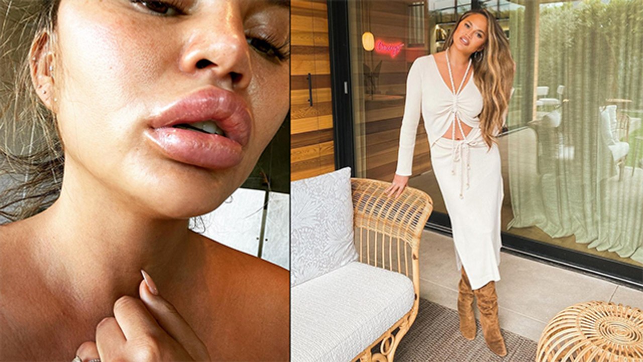 Chrissy Teigen Refutes Getting Lip Filler Rumours After Debuting With Swollen Lip On IG