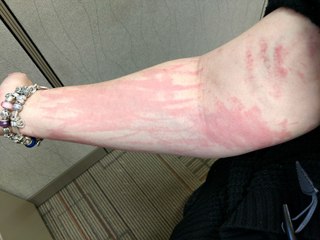 أغرب أنواع الحساسية، بعضها بسبب التمارين الرياضية والواي فاي