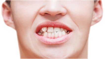 आपके भी है टेढ़े मेढ़े दांत तो भूलकर भी ना करें ये गलती | Crooked Teeth | Boldsky