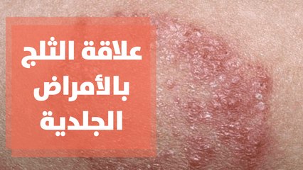 علاقة الثلج والبرد بالامراض الجلدية