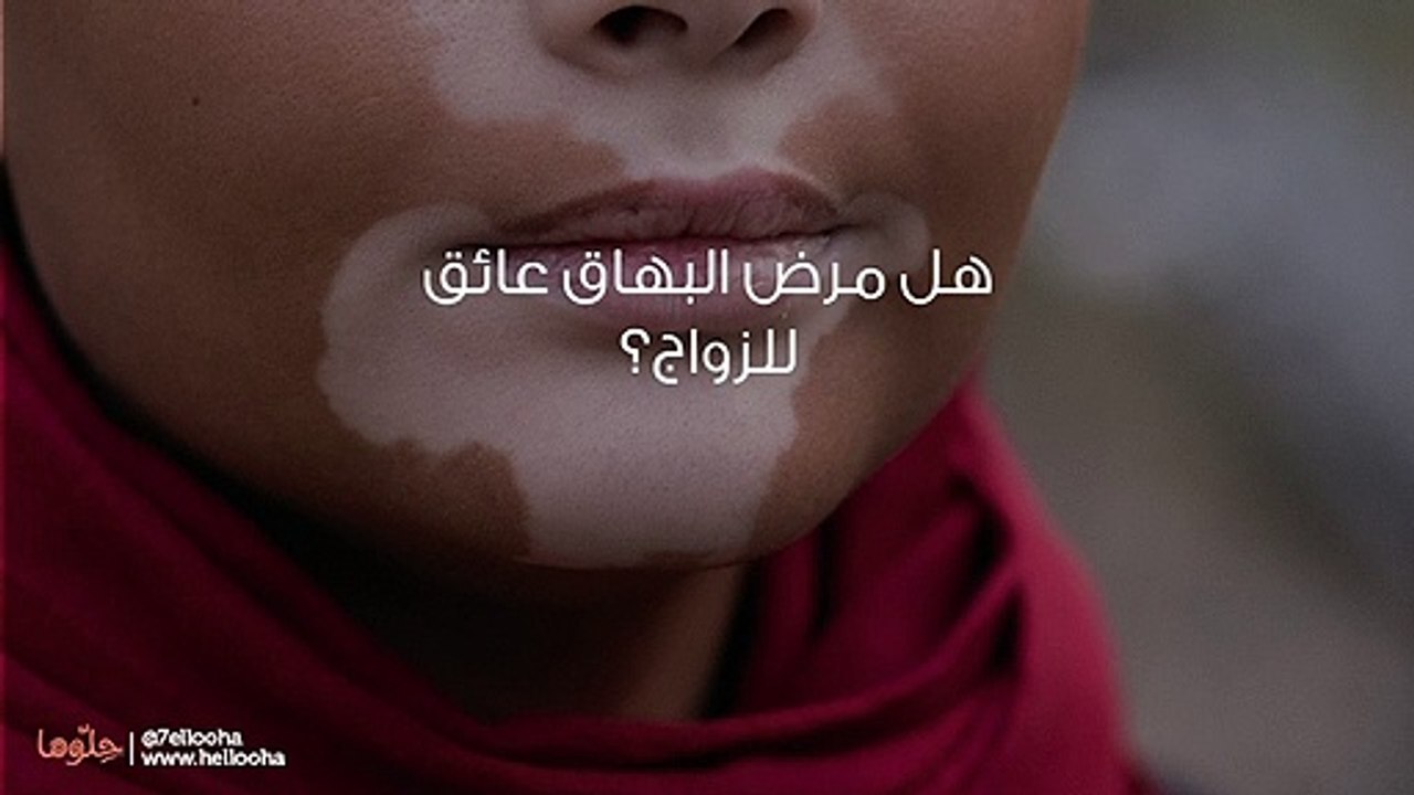 هل مرض البهاق عائق للزواج؟