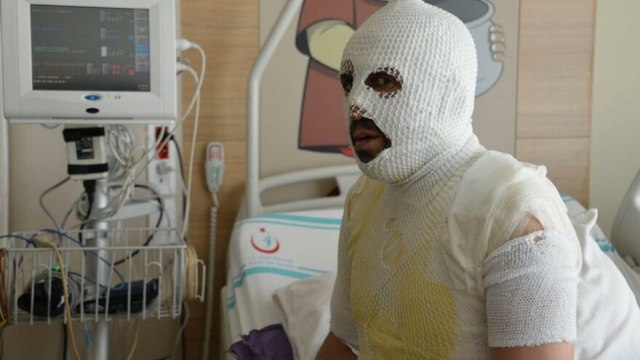 Akrabaları tarafından kaynar suyla yakıldığını iddia etti