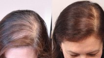 बाल दोबारा उगाने का जबरदस्त तरीका | Baal Dobara Ugane Ka Jabardast Tarika | Boldsky