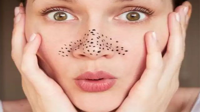 ब्लैकहेड्स से छुटकारा पाने के लिए घरेलू उपाय | ब्लैकहेड्स निकालने का आसान तरीका | Boldsky