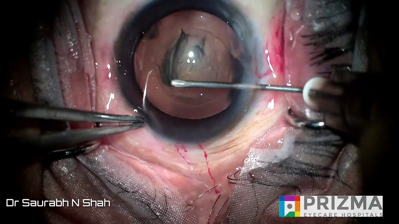 Phacoemulsification Procedure Explained | Ultramodern Cataract Surgery