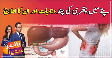 Some of the causes of gallstone and its cure