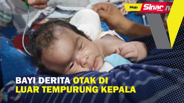 Bayi derita otak di luar tempurung kepala