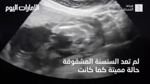 بالفيديو.. استخراج جنين من رحم أمه لعلاجه ثم اعادته لاستكمال الحمل!